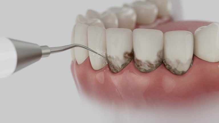 Trusted Wisdom Tooth Removal service in Lewiston, MN - Dentist Open Now